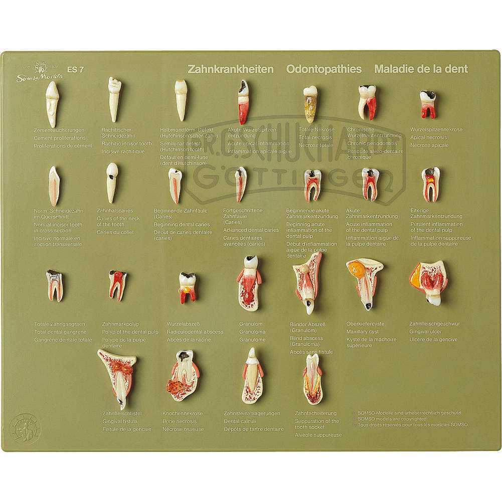 Schaukasten "Zahnkrankheiten" Modell SOMSO®